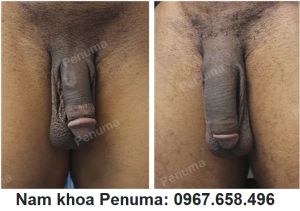 Tăng kích thước dương vật bằng miếng độn Penuma, khách Mỹ - ca 53