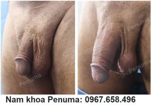 Tăng kích thước cậu nhỏ bằng tấm độn Penuma, khách hàng Mỹ -ca 55