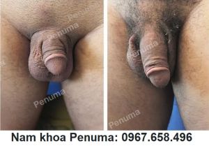 Nâng cấp cậu nhỏ bằng miếng độn Penuma, khách hàng Mỹ - ca 57