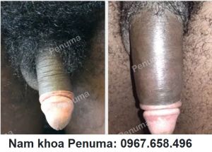 Độn to dài dương vật bằng tấm Penuma, khách hàng Mỹ - ca 58