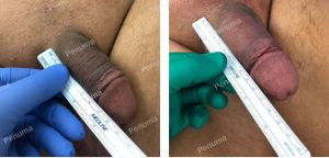 Độn to dài dương vật bằng tấm Penuma, khách hàng Mỹ - ca 60