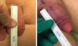 Nâng cấp cậu nhỏ bằng miếng độn Penuma - ca 61