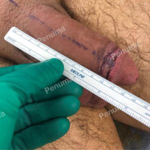 Nâng cấp cậu nhỏ bằng tấm độn Penuma, khách hàng Mỹ - ca 62