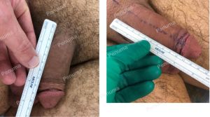 Nâng cấp cậu nhỏ bằng tấm độn Penuma, khách hàng Mỹ - ca 62