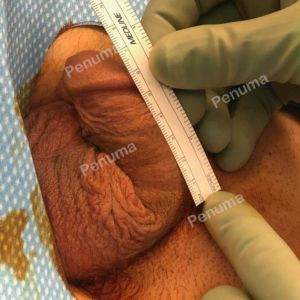 Tăng kích thước dương vật bằng tấm độn Penuma, khách hàng Mỹ - ca 63