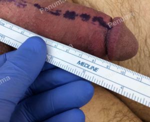 Đặt tấm độn Penuma làm to dài dương vật, khách hàng Mỹ - ca 66