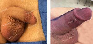 Làm to dài dương vật bằng miếng độn Penuma, khách hàng Mỹ - ca 67