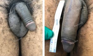 Độn dương vật bằng tấm Penuma, khách hàng Mỹ - ca 69