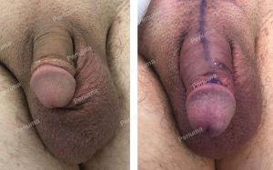 Độn dương vật bằng miếng Penuma, khách hàng Mỹ - ca 70