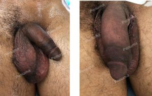 Độn dương vật bằng Penuma, khách hàng Mỹ - ca 73