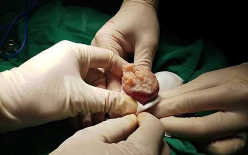 Nhận biết và phòng ngừa bệnh ung thư dương vật - Nam khoa Penuma