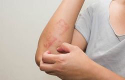 Dầu ô liu và quả ô liu có gây dị ứng không?