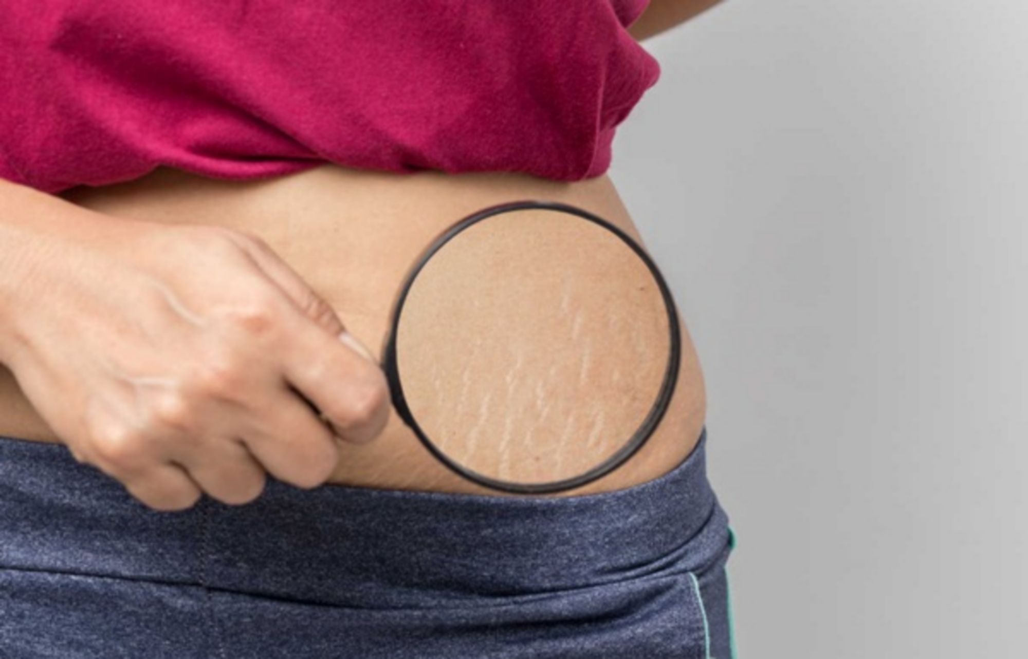 11 cách trị rạn da nên thử