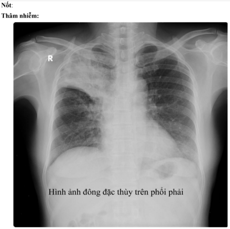 Xquang trong chẩn đoán lao phổi - Bộ y tế 2015