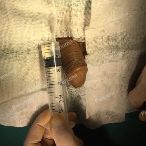 Làm To Dài Cậu Nhỏ, Độn Mô Da Nhân Tạo Đường Mu, Khách Hàng Nam Hà Nội - Ca 77