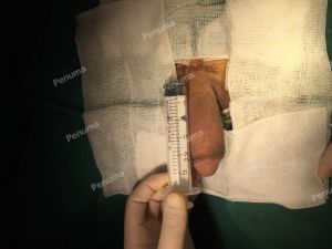 Làm To Dài Cậu Nhỏ, Độn Mô Da Nhân Tạo Đường Mu, Khách Hàng Nam Hà Nội - Ca 77