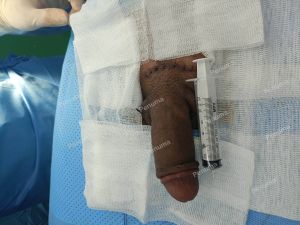 Tăng kích thước dương vật, khách hàng nam 30 tuổi TP.HCM - ca 74