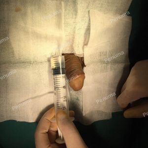 Làm To Dài Cậu Nhỏ, Độn Mô Da Nhân Tạo Đường Mu, Khách Hàng Nam Hà Nội - Ca 77