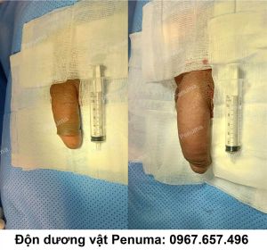 Độn mô da làm to dài dương vật, nam 38 tuổi TP.HCM - ca 76