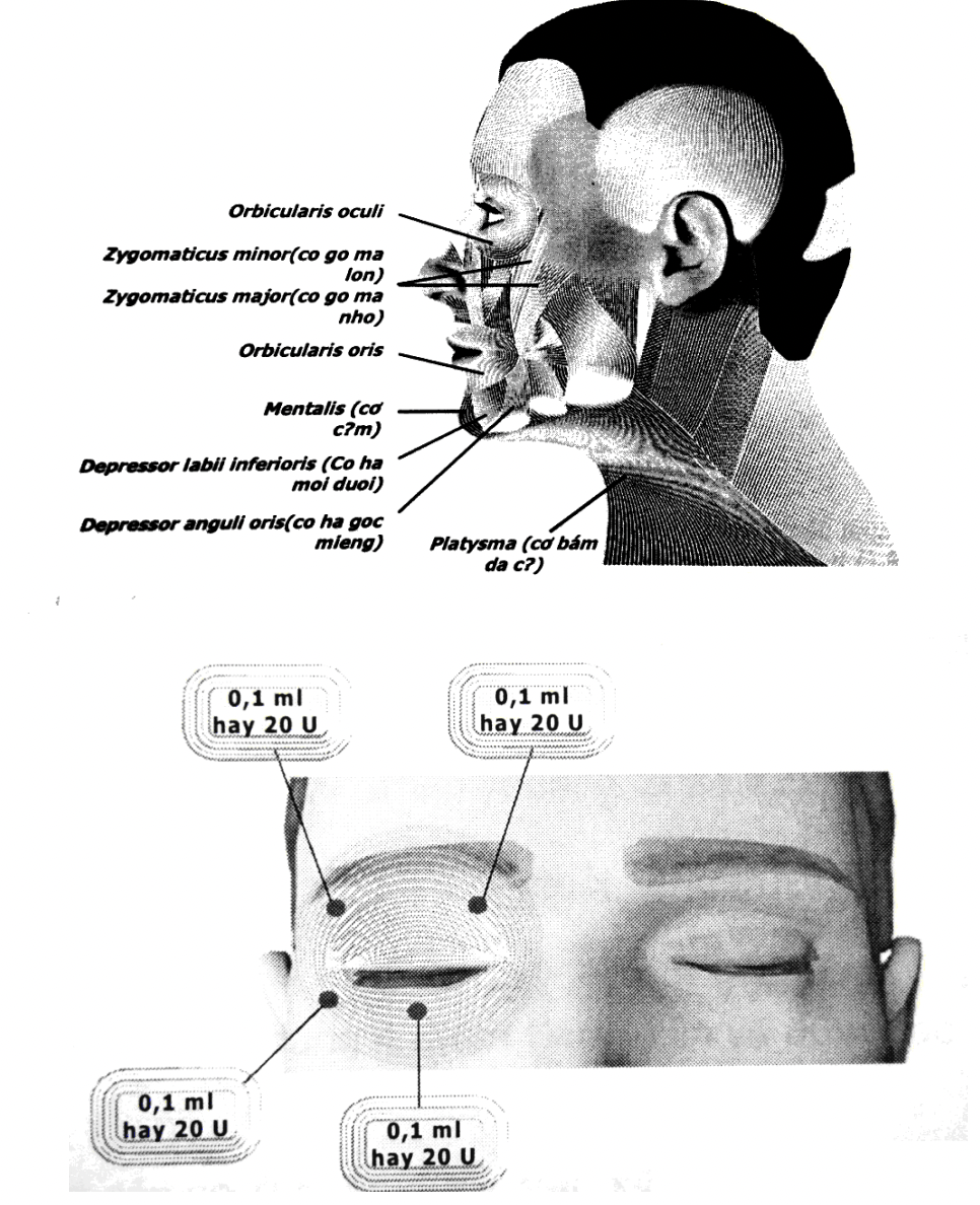 i u tr ch ng co th t n a m t b ng ti m Botulinum toxin A