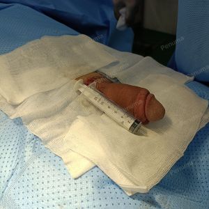 Tăng kích thước dương vật bằng tấm độn sinh học, đường mổ ở mu, khách hàng 33 tuổi HCM - ca 113