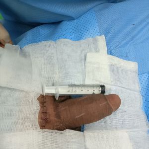 Độn dương vật bằng mô da nhân tạo, đường mổ ở mu, khách hàng 38 tuổi Bình Dương - ca 102