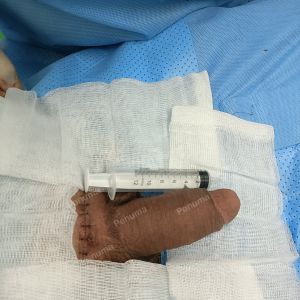 Độn dương vật bằng mô da nhân tạo, đường mổ ở mu, khách hàng 38 tuổi Bình Dương - ca 102