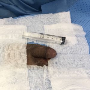 Tăng kích thước dương vật bằng mô da nhân tạo, đường mổ ở mu, khách hàng 30 tuổi An Giang - ca 111