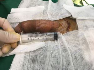 Độn dương vật bằng mô da nhân tạo, đường mổ ở mu, khách hàng 35 tuổi Quảng Ninh - ca 100