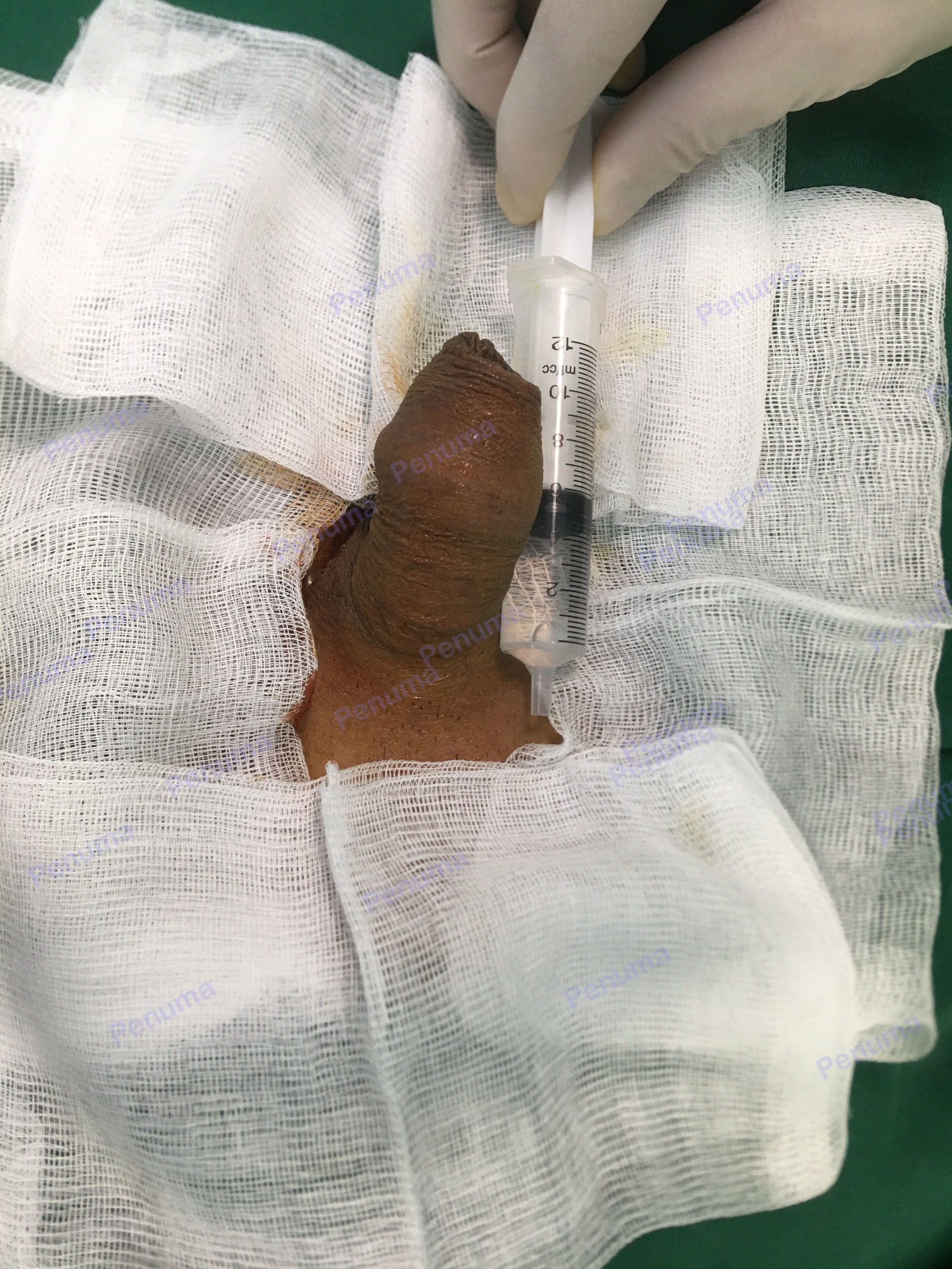 Độn dương vật bằng mô da nhân tạo, đường mổ ở mu, khách hàng 35 tuổi Quảng Ninh - ca 100