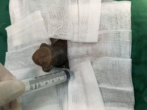 Độn dương vật bằng mô da nhân tạo, đường mổ ở mu, khách hàng 42 tuổi Ninh Bình - ca 110