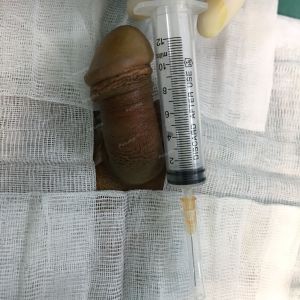 Độn dương vật bằng tấm độn megaderm, đường mổ ở mu, khách hàng 33 tuổi Hà Nội - ca 114