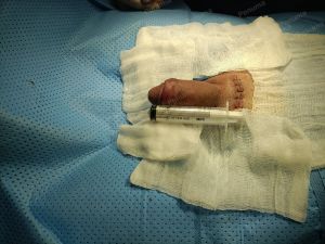 Tăng kích thước dương vật bằng mô da nhân tạo, đường mổ ở mu, khách hàng 30 tuổi An Giang - ca 111