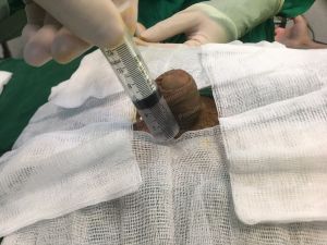 Độn dương vật bằng mô da nhân tạo, đường mổ ở mu, khách hàng 29 tuổi Hà Nội - ca 106