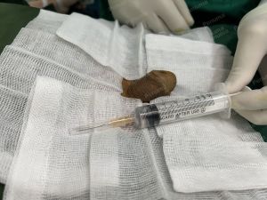 Tăng kích thước cậu nhỏ bằng tấm độn sinh học, đường mổ ở mu, khách hàng 42 tuổi, Thanh Hóa -  ca 120