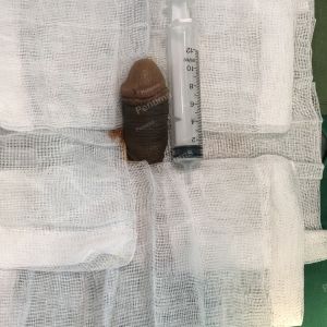 Tăng kích thước dương vật bằng mô da nhân tạo, đường mổ ở mu, khách hàng 38 tuổi Hà Nội- ca 89