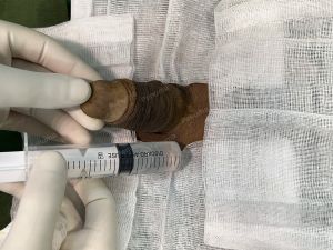 Động dương vật bằng mô da nhân tạo, đường mổ ở mu, khách hàng 43 tuổi, Lào Cai - ca 123