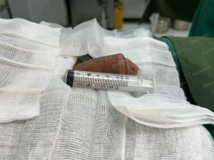 Tăng kích thước cậu nhỏ bằng tấm độn sinh học, đường mổ ở mu, khách hàng 42 tuổi, Thanh Hóa -  ca 120