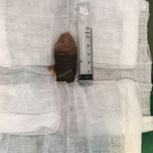 Tăng kích thước dương vật bằng mô da nhân tạo, đường mổ ở mu, khách hàng 38 tuổi Hà Nội- ca 89