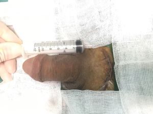 Tăng kích thước bằng mô da nhân tạo, đường mổ ở mu, khách hàng 35 tuổi Hà Nội - ca 109