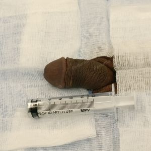 Tăng kích thước dương vật bằng mô da nhân tạo, đường mổ ở mu, khách hàng 34 tuổi HCM - ca 101