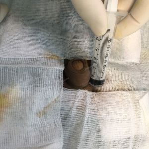 Độn dương vật bằng mô da nhân tạo, đường mổ ở mu, khách hàng 38 tuổi Thái Bình - ca 108