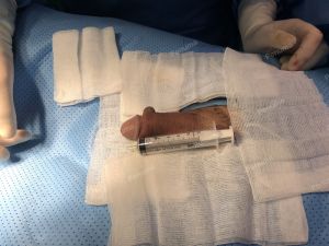 Tăng kích thước dương vật bằng mô da nhân tạo, đường mổ ở mu, khách hàng 36 tuổi Quy Nhơn - ca 81