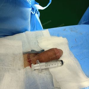 Tăng kích thước dương vật bằng tấm độn sinh học, đường mổ ở mu, khách hàng 33 tuổi HCM - ca 113