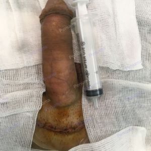 Độn dương vật bằng mô da nhân tạo, đường mổ ở mu, khách hàng 35 tuổi Quảng Ninh - ca 100