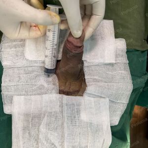 Động dương vật bằng mô da nhân tạo, đường mổ ở mu, khách hàng 43 tuổi, Lào Cai - ca 123