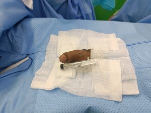 Độn dương vật bằng mô da nhân tạo, đường mổ ở mu, khách hàng 38 tuổi Bình Dương - ca 102