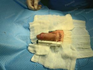 Tăng kích thước dương vật bằng mô da nhân tạo, đường mổ ở mu, khách hàng 30 tuổi An Giang - ca 111