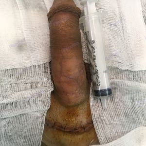 Độn dương vật bằng mô da nhân tạo, đường mổ ở mu, khách hàng 35 tuổi Quảng Ninh - ca 100