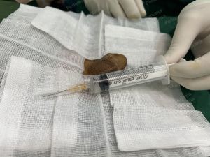 Tăng kích thước cậu nhỏ bằng tấm độn sinh học, đường mổ ở mu, khách hàng 42 tuổi, Thanh Hóa -  ca 120